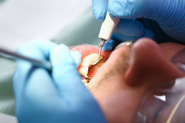 Best Emergency Wisdom Tooth Extraction in Clarksville, IA