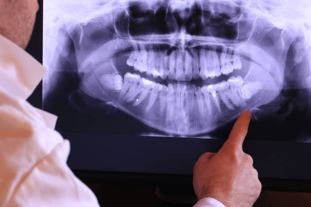 Best Emergency Wisdom Tooth Extraction in Clarksville, IA