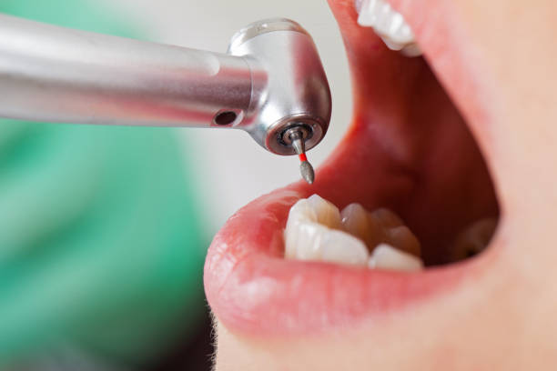 Best Emergency Root Canal Therapy in Clarksville, IA